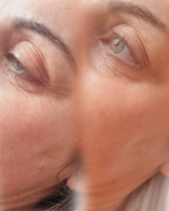 Lift visage avant apres brest